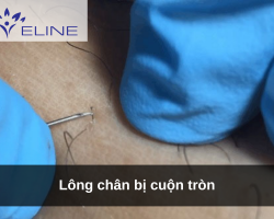 Lông chân bị cuộn tròn
