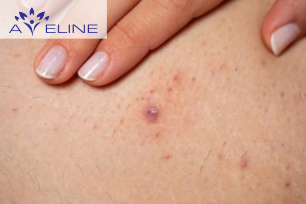 Biểu hiện thường gặp của lông chân bị cuộn tròn 