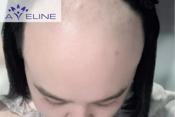 Cạo trọc đầu bao lâu tóc mọc lại