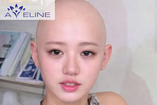 Giai đoạn khó coi khi tóc mọc lại 