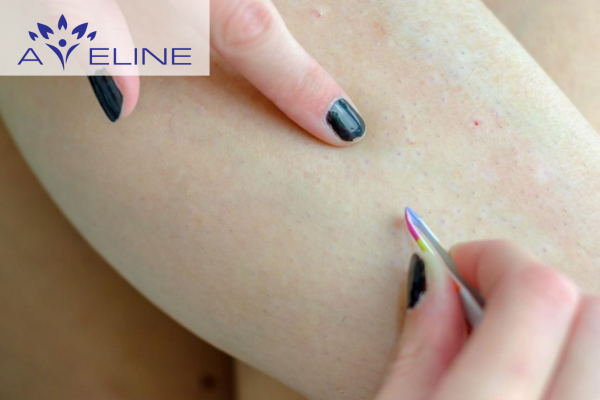 Lông chân bị cuộn tròn có nguy hiểm không? 