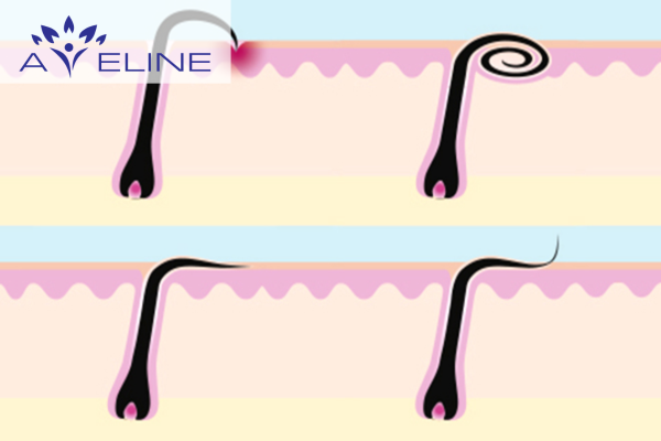 Lông chân bị cuộn tròn là gì? 