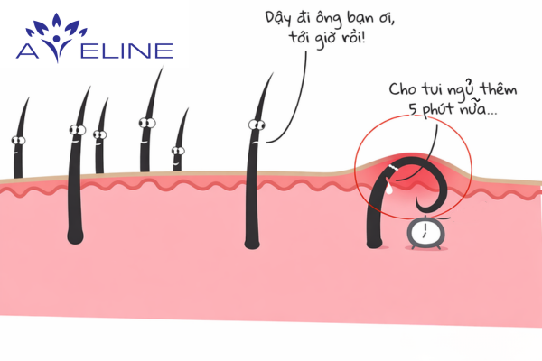 Lông mọc dưới da là gì? 
