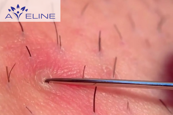 Nguyên nhân khiến lông chân bị cuộn tròn 