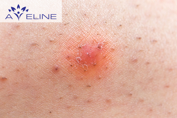 Vì sao cần làm lông mọc dưới da trồi lên? 