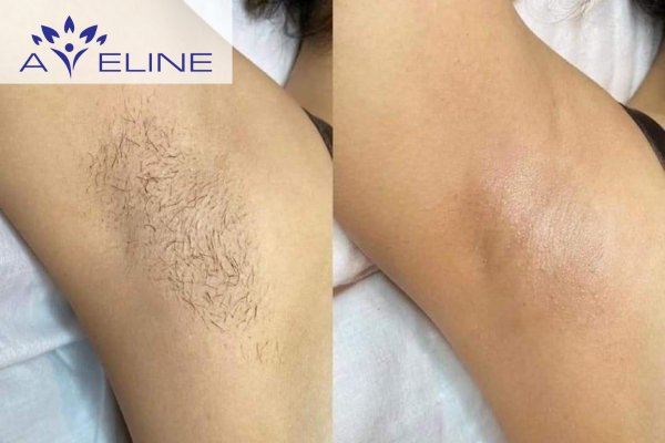 Vì sao lông nách quan trọng?